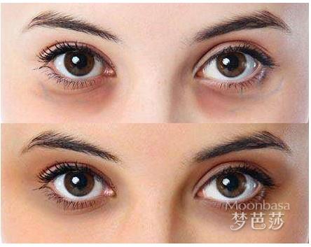 有黑眼圈是怎么回事
